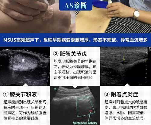 成都西部痛风风湿医院强直诊断