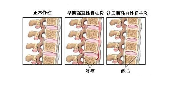 导致强直性脊柱炎的病因有哪些?